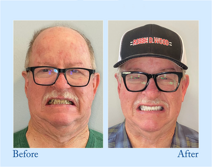 Yagoo™ -🦷Advanced Customized Full Denture Set🦷 (⏰Limited time discount last 30 minutes⏰)💥