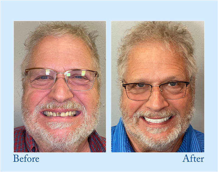 Yagoo™ -🦷Advanced Customized Full Denture Set🦷 (⏰Limited time discount last 30 minutes⏰)💥
